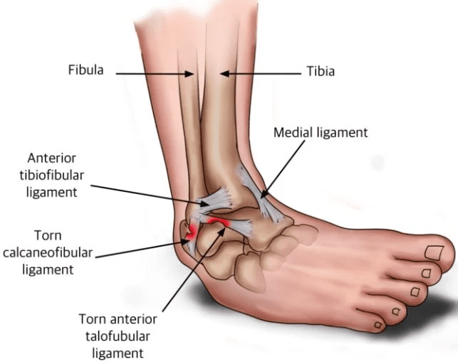 Lateral ankle sprain (inversion)
