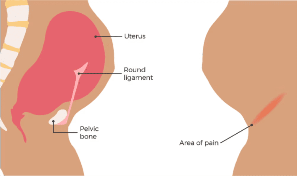 Image of pregnant woman and round ligament