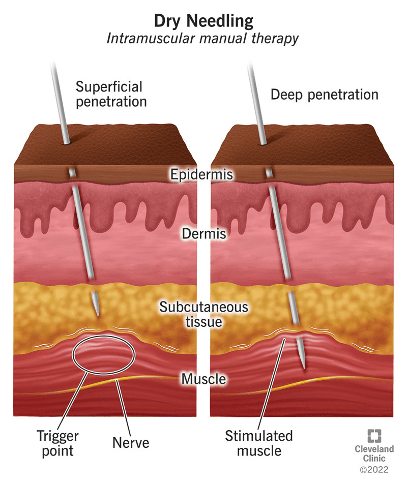 Dry Needling Diagram